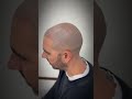Qué Es La Micropigmentación Capilar