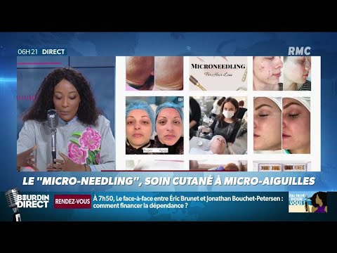 "J'ai testé pour vous": le 'micro-needling', le soin...