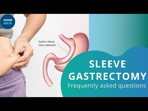 Surgical Weight Loss -Frequently Asked Questions (Sleeve Gastrectomy)