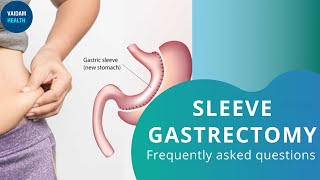 Sleeve Gastrectomy - Frequently Asked Questions