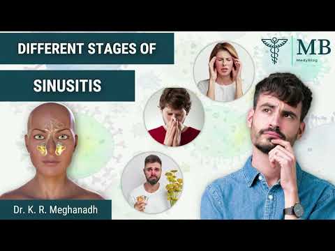 Stages of Sinusitis and how it progresses | Dr. K. R. Meghanadh| Medyblog