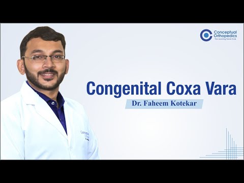 Congenital Coxa Vara | Dr. Faheem Kotekar @ConceptualOrthopedics
