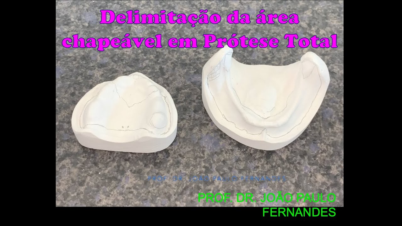 1 - Delimitação da área chapeável em Prótese Total