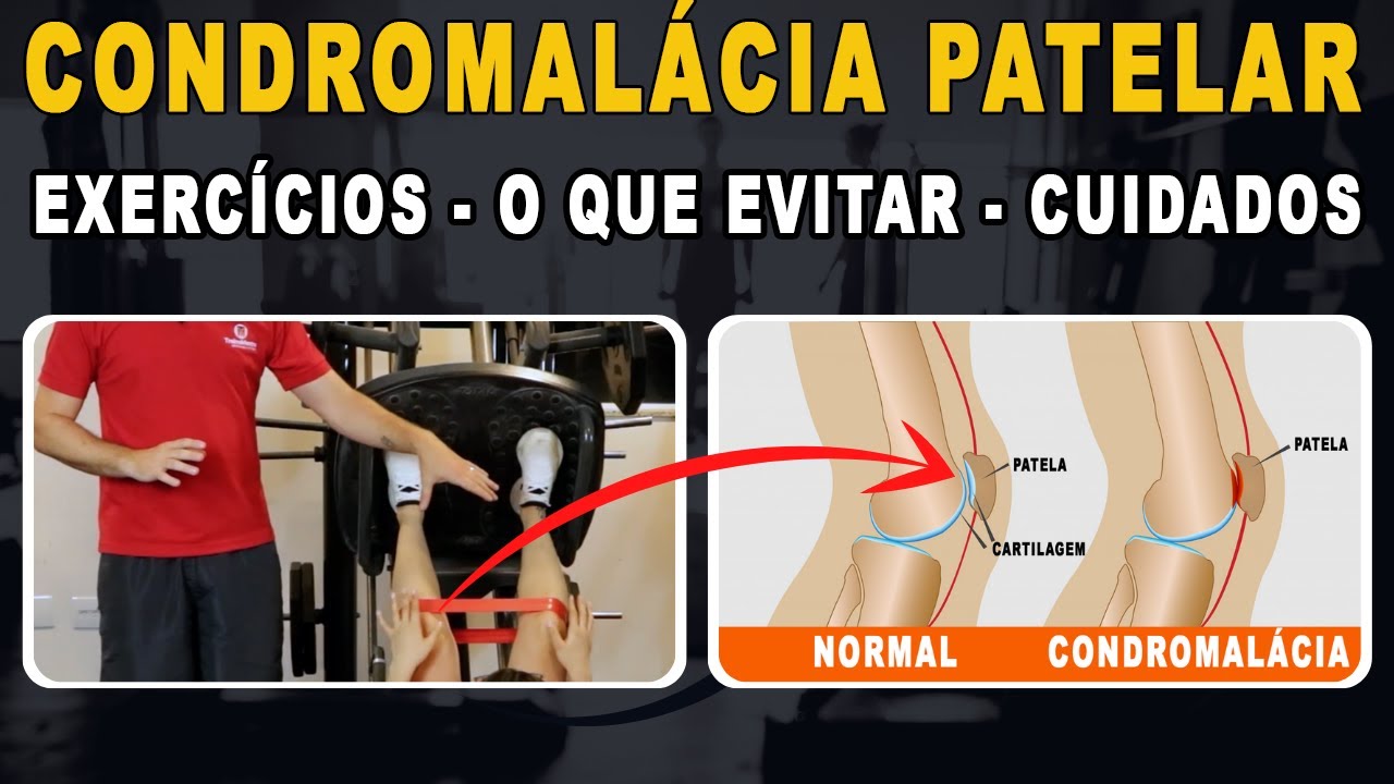 Condromalácia patelar: Exercícios, o que evitar e cuidados