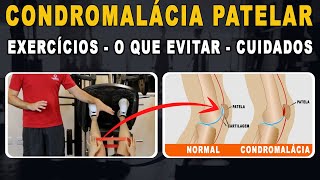 Condromalácia patelar: Exercícios, o que evitar e cuidados