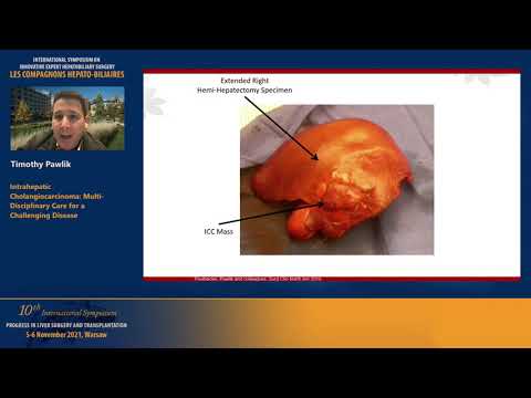 Timothy PAWLIK. Intrahepatic Cholangiocarcinoma: Multi-Disciplinary Care for a Challenging Disease
