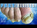Feet Revived:  Toenails and Feet Brought Back to Life