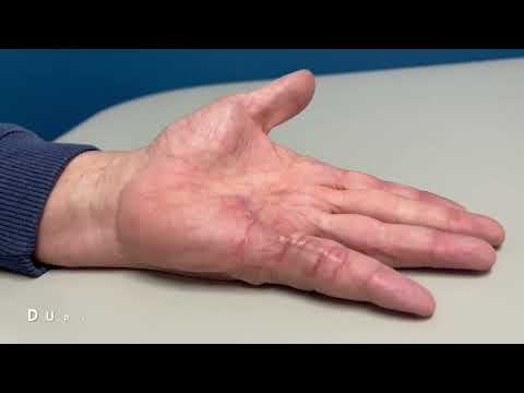 Dupuytren's Contracture Before and After Surgery