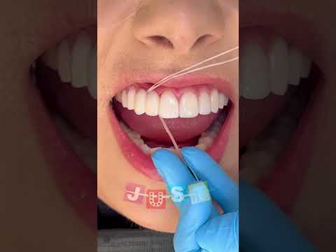 Flossing with a dental bridge 🦷 #dentistry