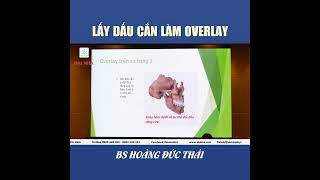 [Học chỉnh nha] - Lấy dấu cắn làm Overlay. Giảng dạy bs Hoàng Đức Thái. #niengrang #nhakhoa