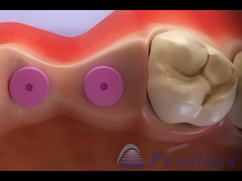 Atrofia post extracción dentaria ©