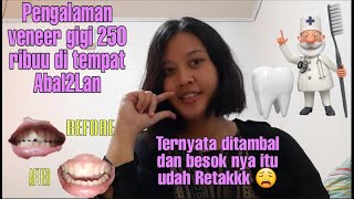 VENEER GIGI MURAH 250 RIBU PENGALAMAN
