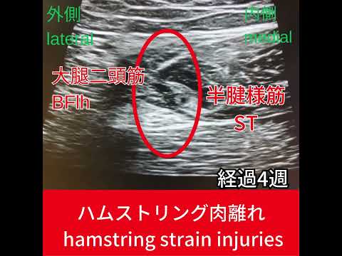 【エコー動態】ハム肉離れ再発予防｜BFlhエコー動態