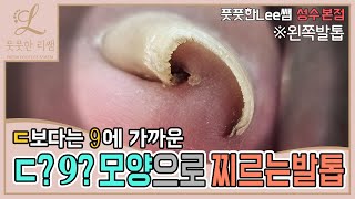 ㄷ자! 9 모양으로 찌르는 발톱! 어떻게 관리해야 할까요? ingrown toenail / ingrowing nail - Fresh Foot 풋풋한리쌤 성수본점