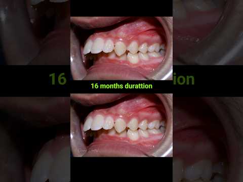 Braces for buck teeth, 16 months #braces #orthodontist #dentaltreatment #dentist