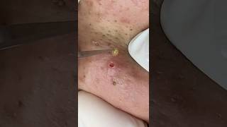 #blackheads #sacdepspa #treatments