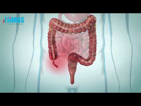 Laparoscopic Appendectomy Procedure | Safe & Advanced Appendix Surgery at Himas Hospital Bangalore