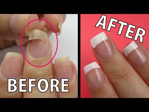 Radikal na paggamot ng kuko halamang-singaw Onychomycosis kuko kaysa sa pagalingin