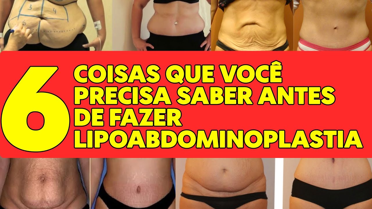 SEIS COISAS QUE VOCÊ PRECISA SABER ANTES DE SUA LIPOABDOMINOPLASTIA