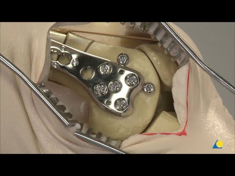 Femur, Distal - Intraarticular Fracture (33C2) - Fixation With VA-LCP Curved Condylar Plate System