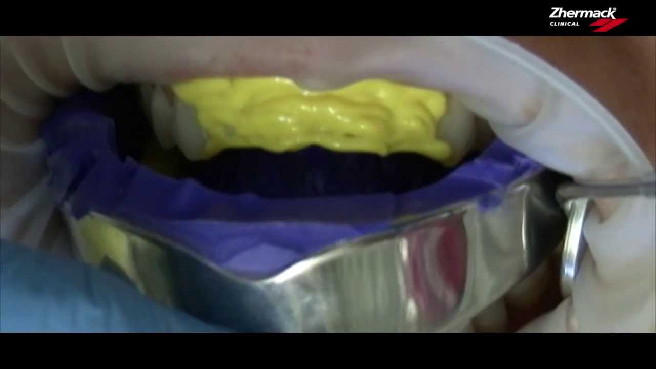 Hydrorise Video deux temps deux viscosites (putty + extra light)