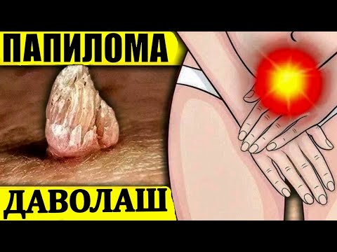 szemölcsök a vulva kezelésén)