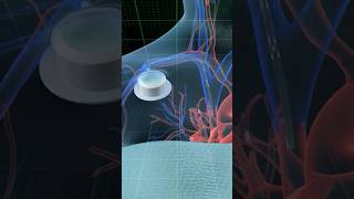 Chemotherapy PORT