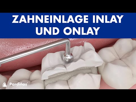 Zahneinlage Inlay und Onlay ©