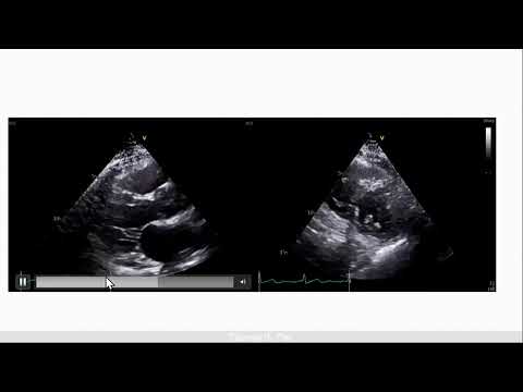 Ss8 Complex Case Diagnostic SOB With Multiple Co morbidities. Can Echo Help Us Freemedbooks.com