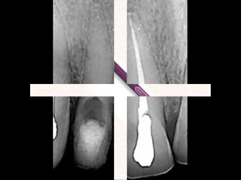 Микро Дебридер, Micro-Debrider, размер 30/02, 3 шт. (Dentsply Sirona) - фото 1 - id-p2489540341