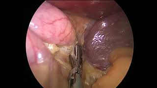 Versa Lifter Band - Sleeve Gastrectomy