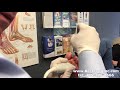 Dehydrated Alcohol Injection For Neuroma -- Live