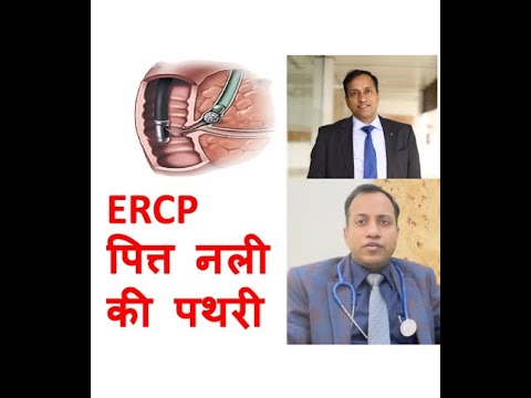 ERCP-CBD (Bile Duct) stone, pitt nali pathari, Dr Vikas Singla, Head Gastroenterology Max Saket