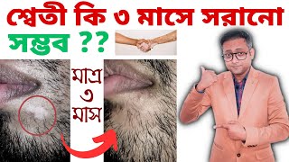 শ্বেতী রোগ কি সরানো সম্ভব | Treatment of Vitiligo | Bengali | Dr Supratim Saha
