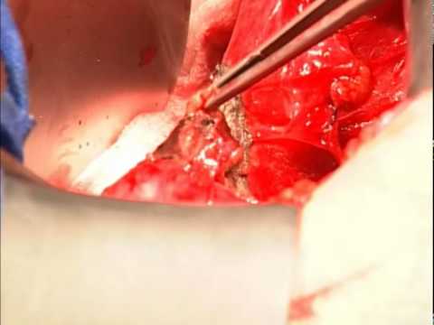 maXium® and marClamp® in hysterectomy – Part 2