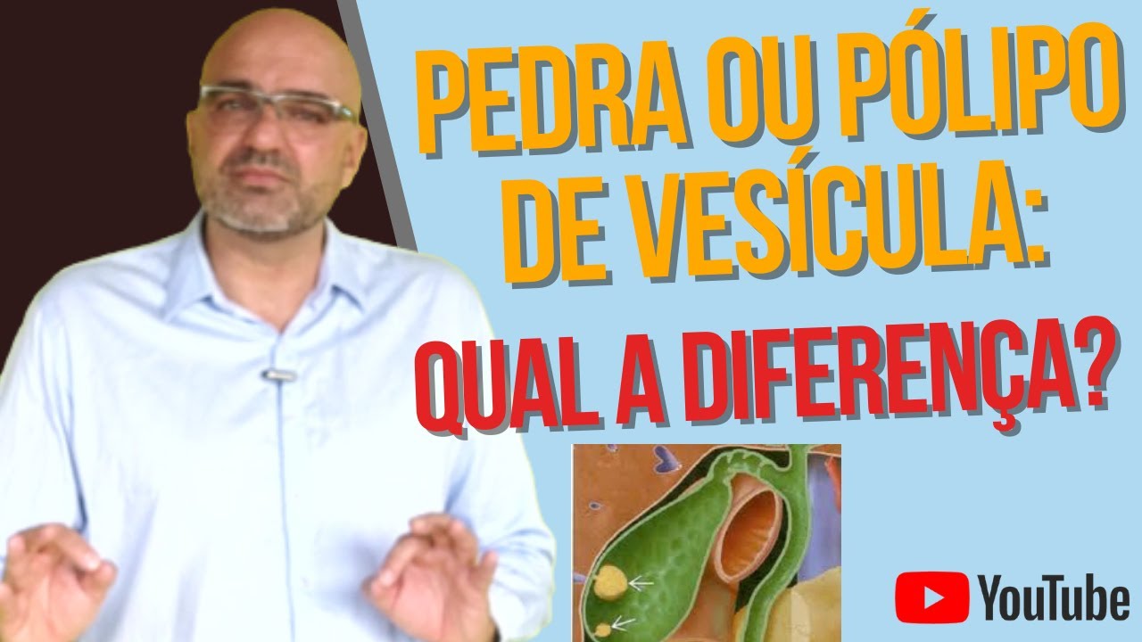 PÓLIPO de VESÍCULA BILIAR: tem que operar?