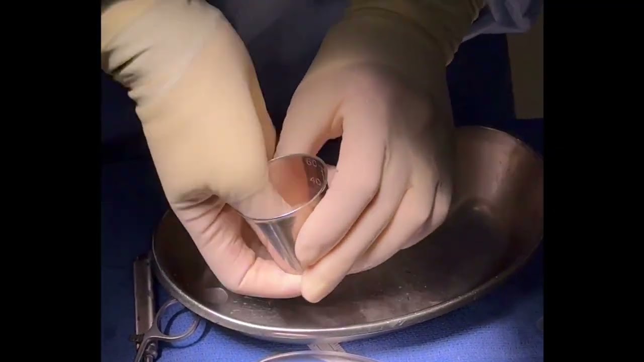 Updated Distal Tibial Allograft Glenoid Reconstruction Surgery