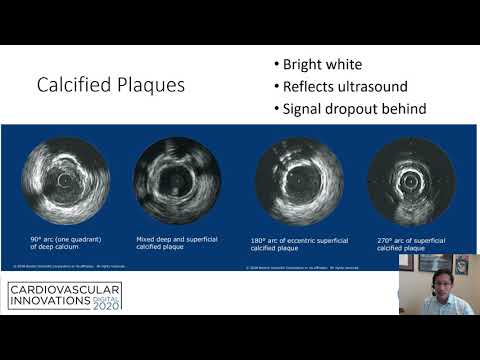IVUS guided PCI: step-by-step_Seto_Coronary On Demand
