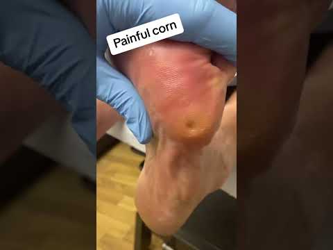 Very painful corn removal from foot by podiatrist with scalpel #foot #callus #podiatrist #ergonx #do