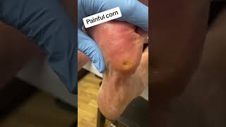 Very painful corn removal from foot by podiatrist with scalpel #foot #callus #podiatrist #ergonx #do