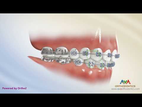 How to Wear Rubber Bands - Class 3 Box on Upper 3, 4 Lower 3, 4