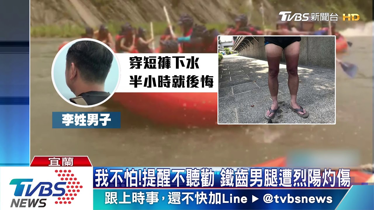 我的腿！男著短褲泛舟　一度灼傷像穿黑襪