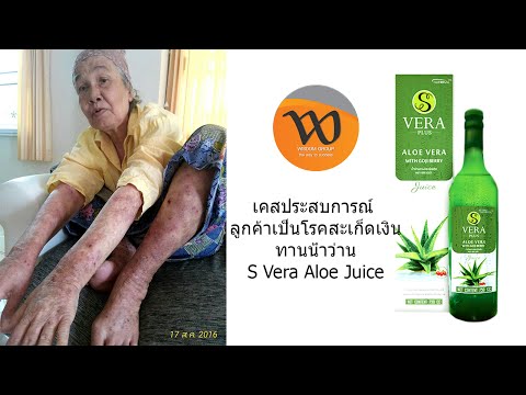 วิธีการรักษากลาก ขนของตัวตุ่นการแสดงความคิดเห็นเป็นโรคสะเก็ดเงิน