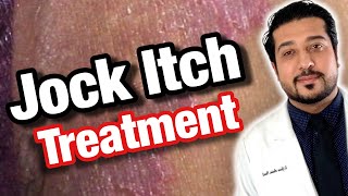How to Treat Jock Itch Fast | Jock Itch Treatment, Causes, and Prevention (2021)