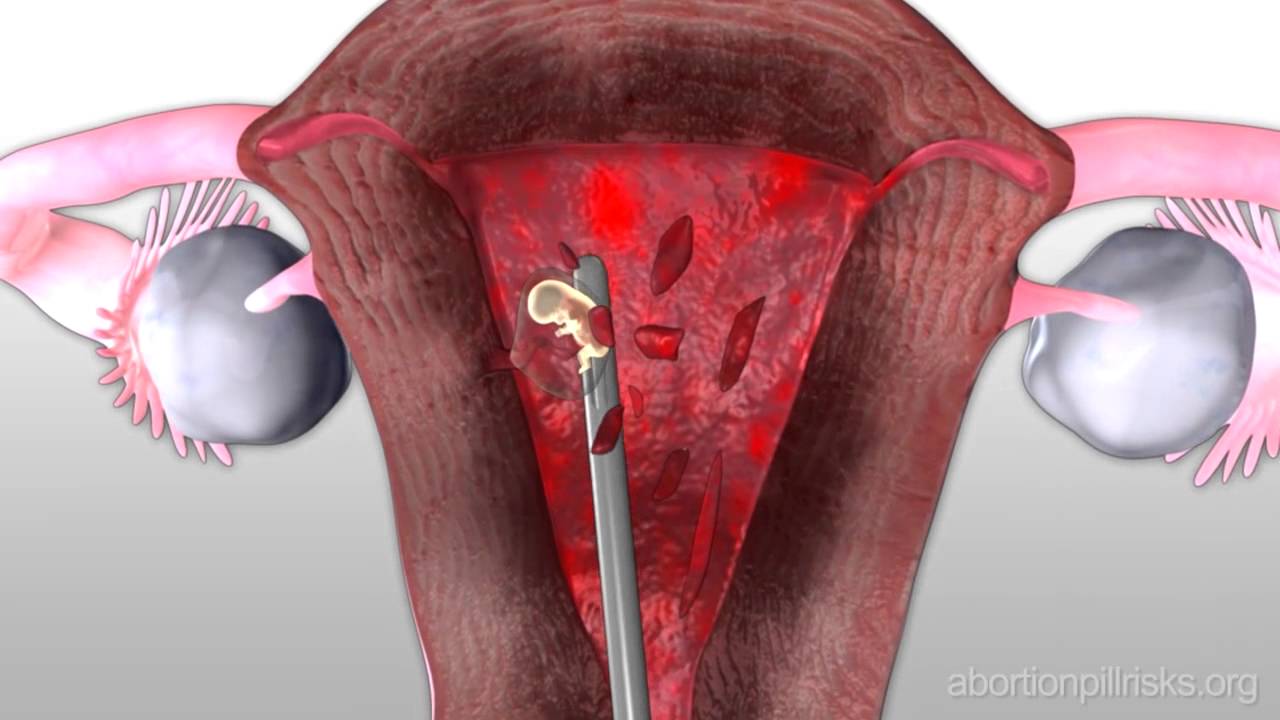 Опасность медикаментозного аборта (на русском)