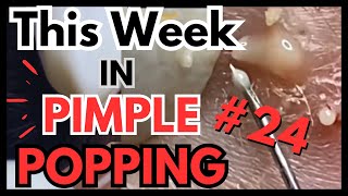 This Week In PIMPLE POPPING #24