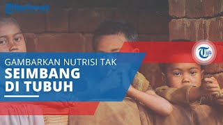 Malnutrisi, Gambarkan Orang yang Makan dengan Cukup tapi Nutrisinya Tidak Seimbang