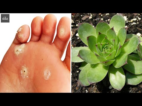 How to cure foot corns in 1 day