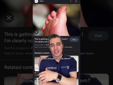 How Should We Treat Blister? LMK!
