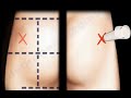 Glute Injection Buttock Injection Everything You Need To Know Dr Nabil Ebraheim